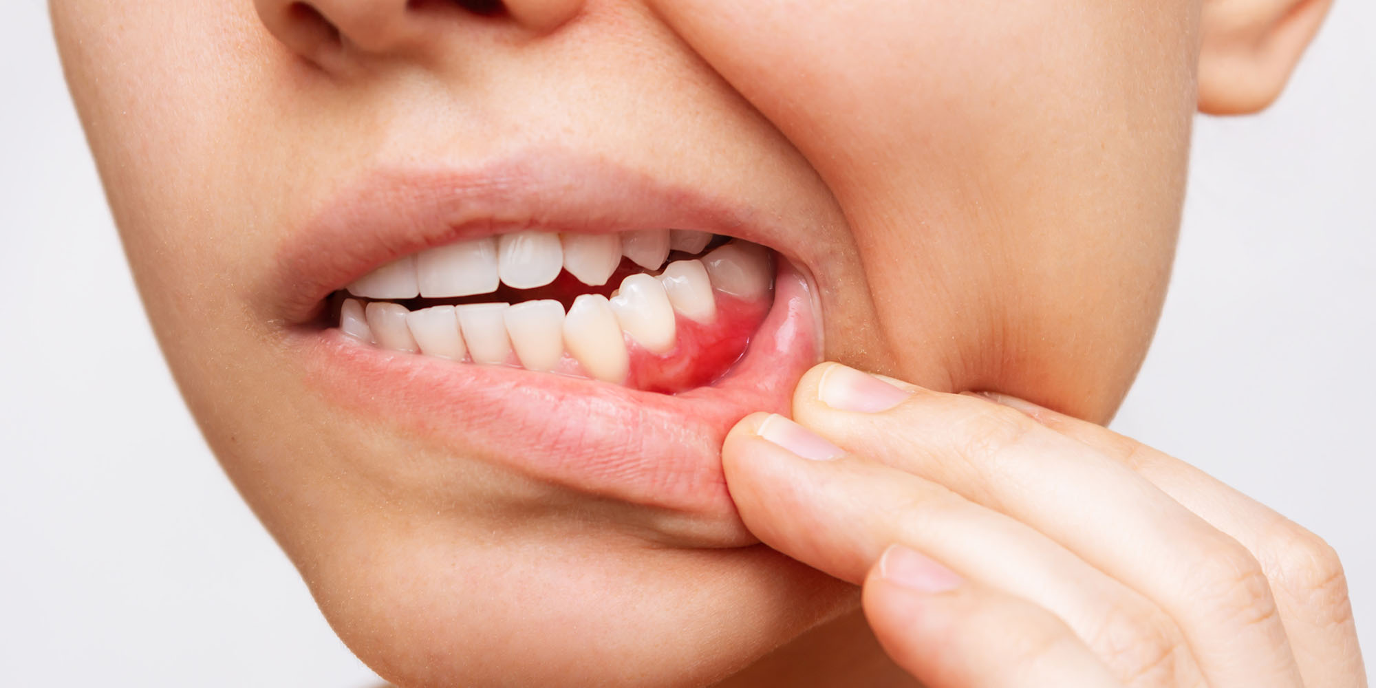 Understanding Gum Disease: Symptoms, Causes, and Treatments