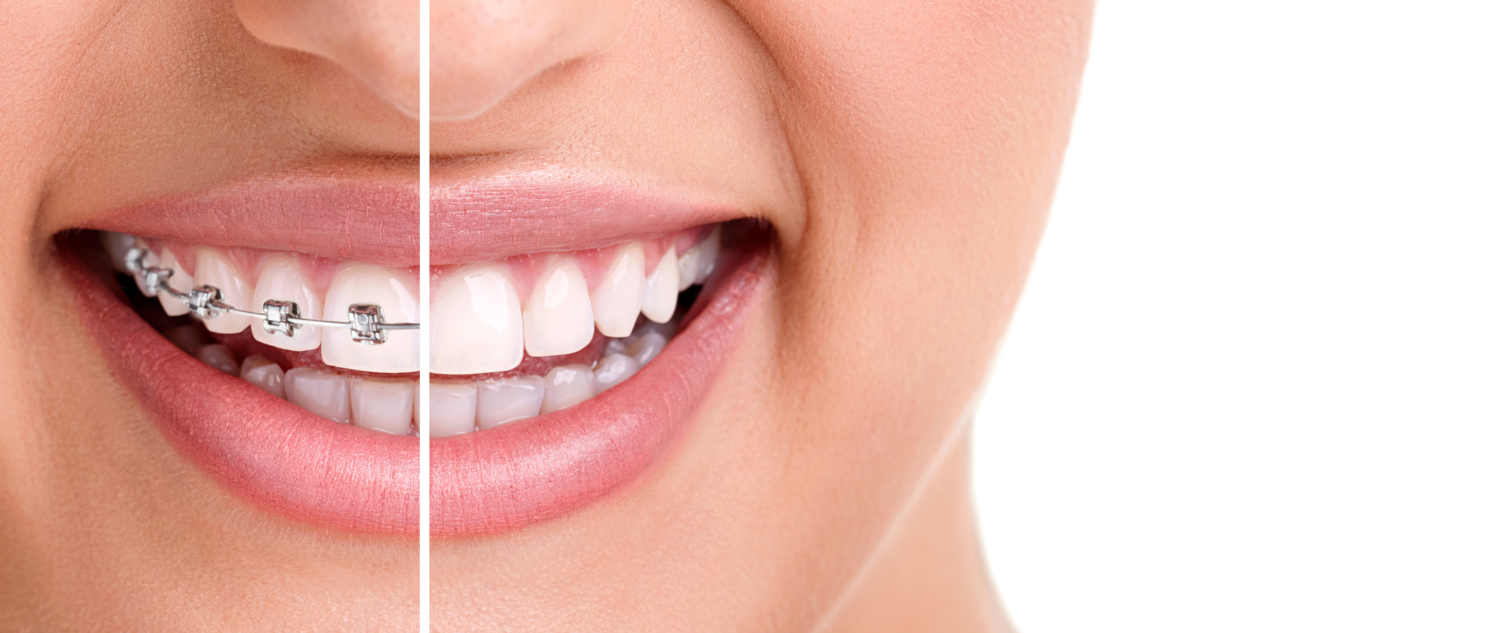 How Clear Aligners Can Transform Your Smile